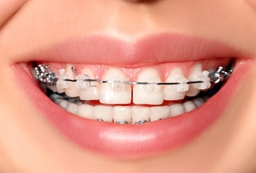 dental braces in meerut