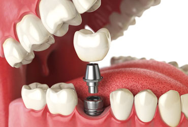 dental implants in meerut